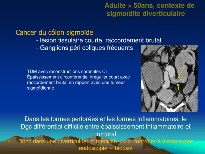 PPT - IMAGERIE DES DOULEURS AIGUES DE LA FOSSE ILIAQUE GAUCHE ...