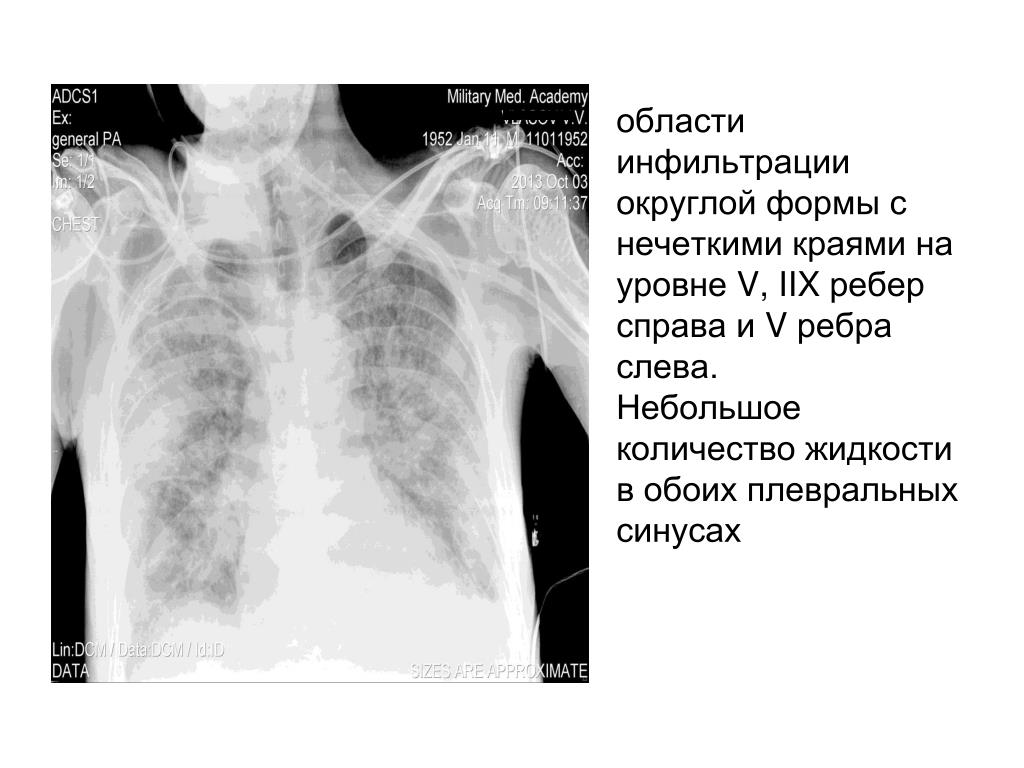 Жидкость в ребрах. Гипоплазия 1 ребра справа. Выпячивание ребер слева.