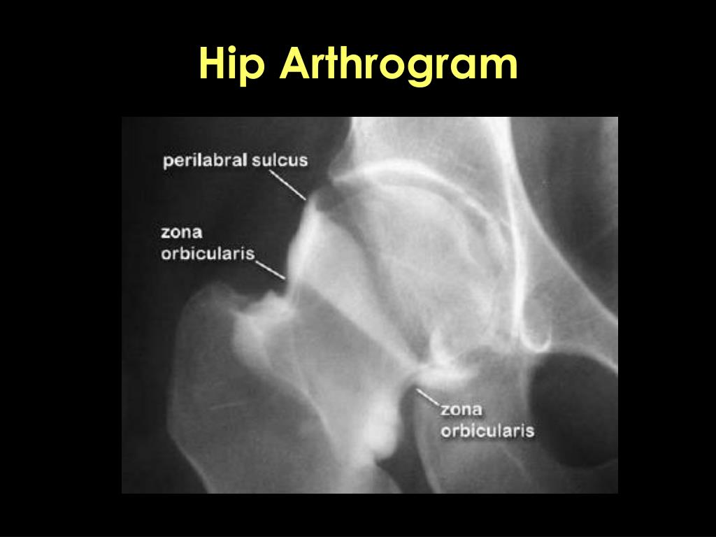 PPT - Application of Hip Arthroscopy PowerPoint Presentation, free