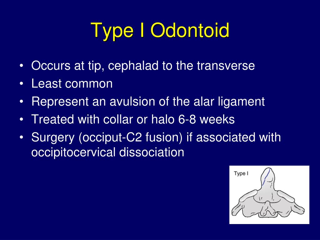 icd10 diagnosis for odontoid fracture type 2