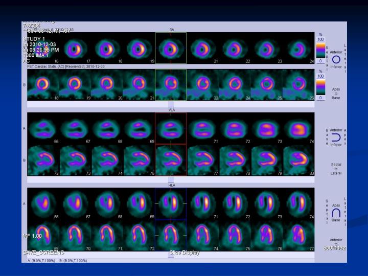 PPT - Myocardial Viability PowerPoint Presentation - ID PPT - Myocardial Viability PowerPoint Presentation - ID