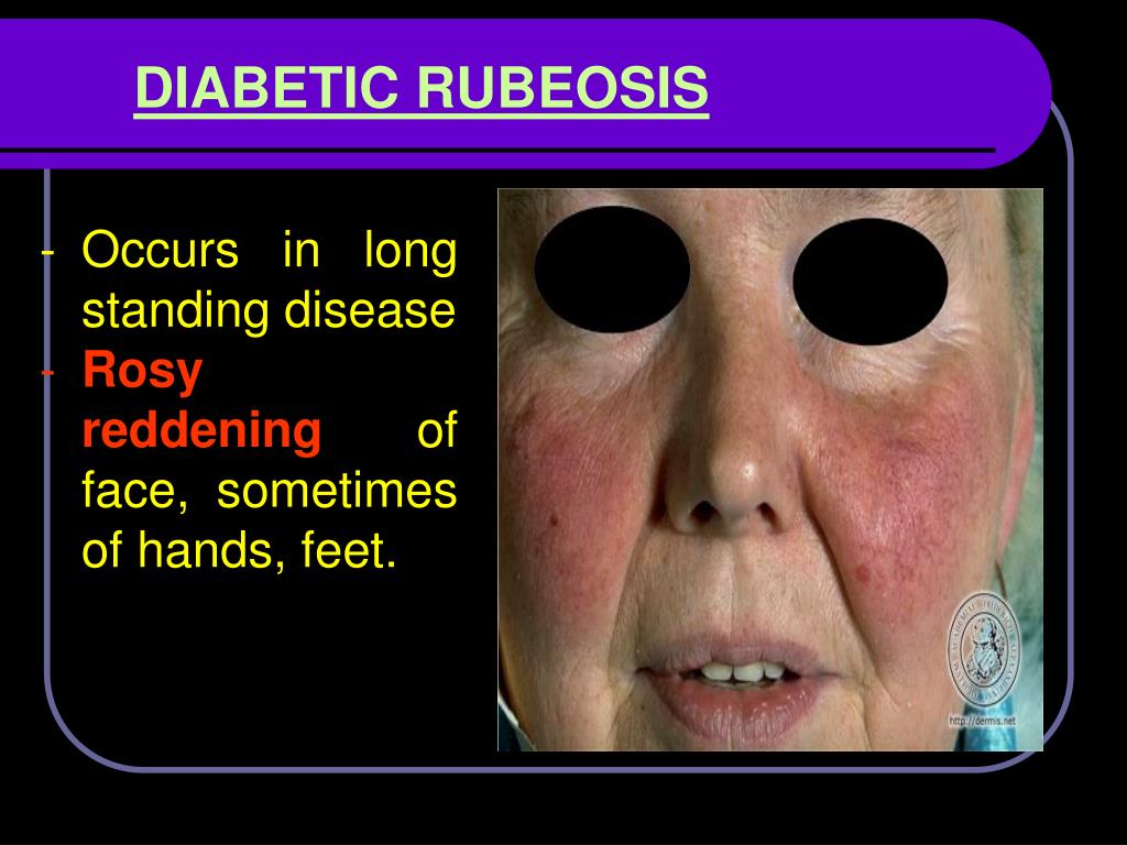 diabetic rubeosis skin)