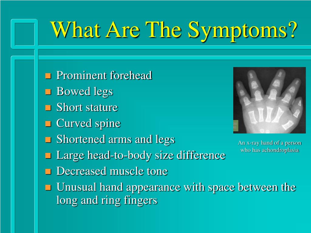 Dwarfism Symptoms
