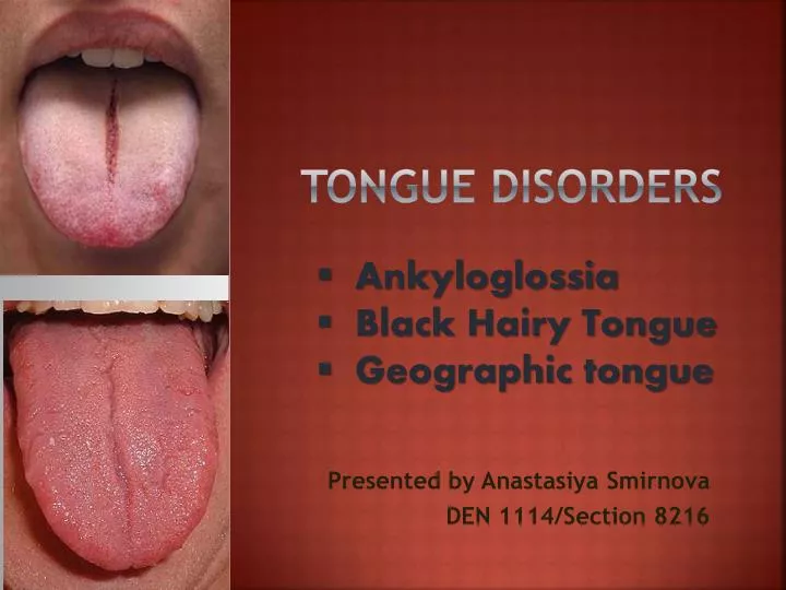 PPT TONGUE DISORDERS PowerPoint Presentation ID5698769