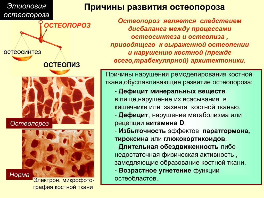 Структурные изменения костей. Структура костной ткани остеопороз. Структура костной ткани порозна что это. Остеопороз этиология. Основная причина развития остеопороза.