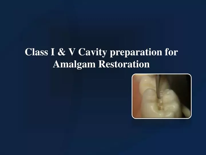 class i v cavity preparation for amalgam restoration n.