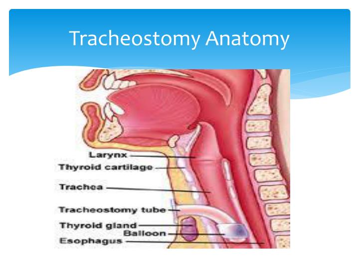 PPT Tracheostomy Care PowerPoint Presentation ID5705059