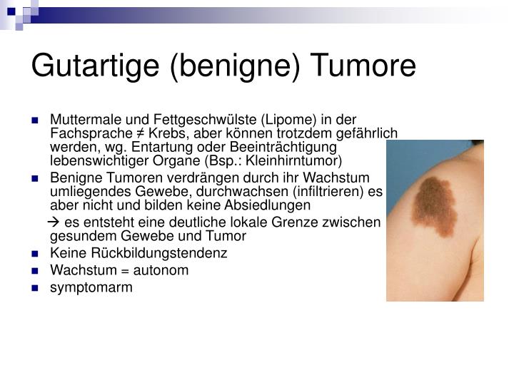 Gutartiger Tumor Im Bauch Symptome