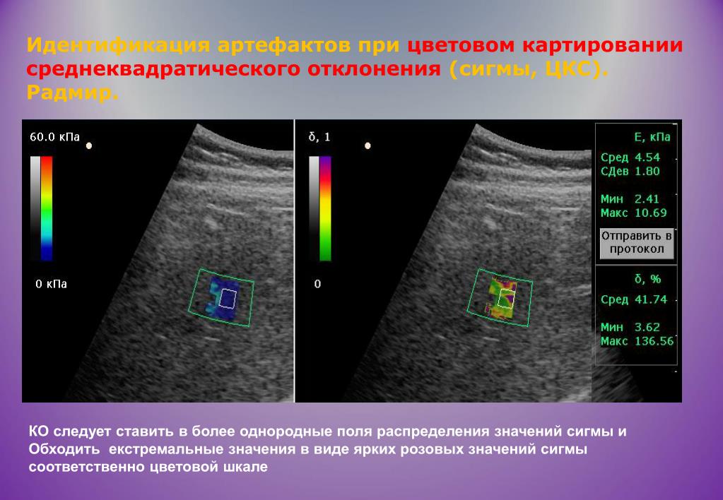Что такое эластография печени Что такое эластография печени