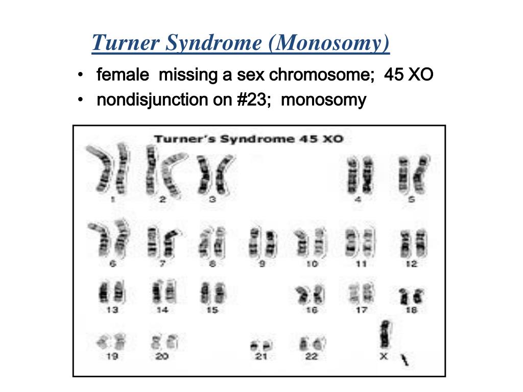 turner syndrome monosomy.