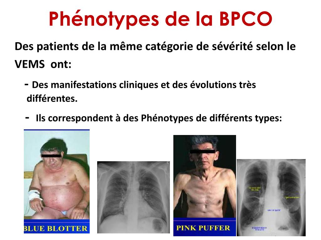PPT - ASTHME ET BPCO où se situe la frontière? PowerPoint Presentation -  ID:5733930