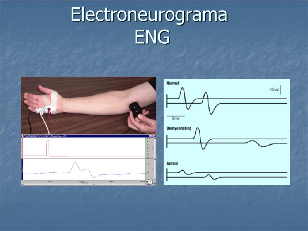 PPT - Electroneurograma ENG PowerPoint Presentation, free download - ID