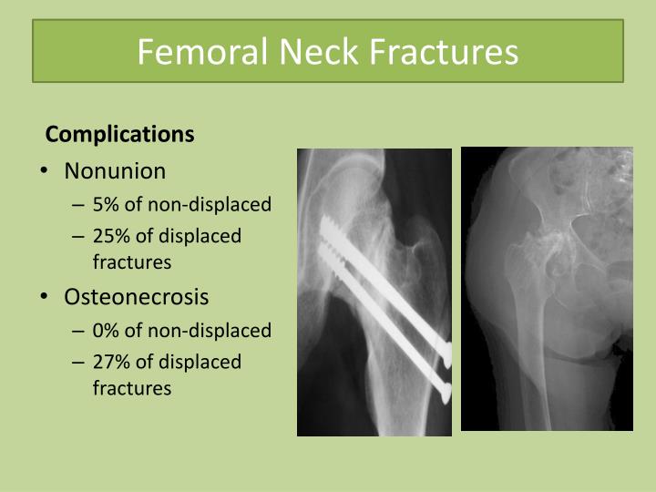 Ppt Common Lower Limb Fracture Powerpoint Presentation Id5737068