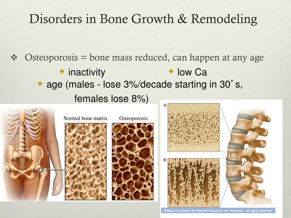 Se puede trabajar con osteoporosis