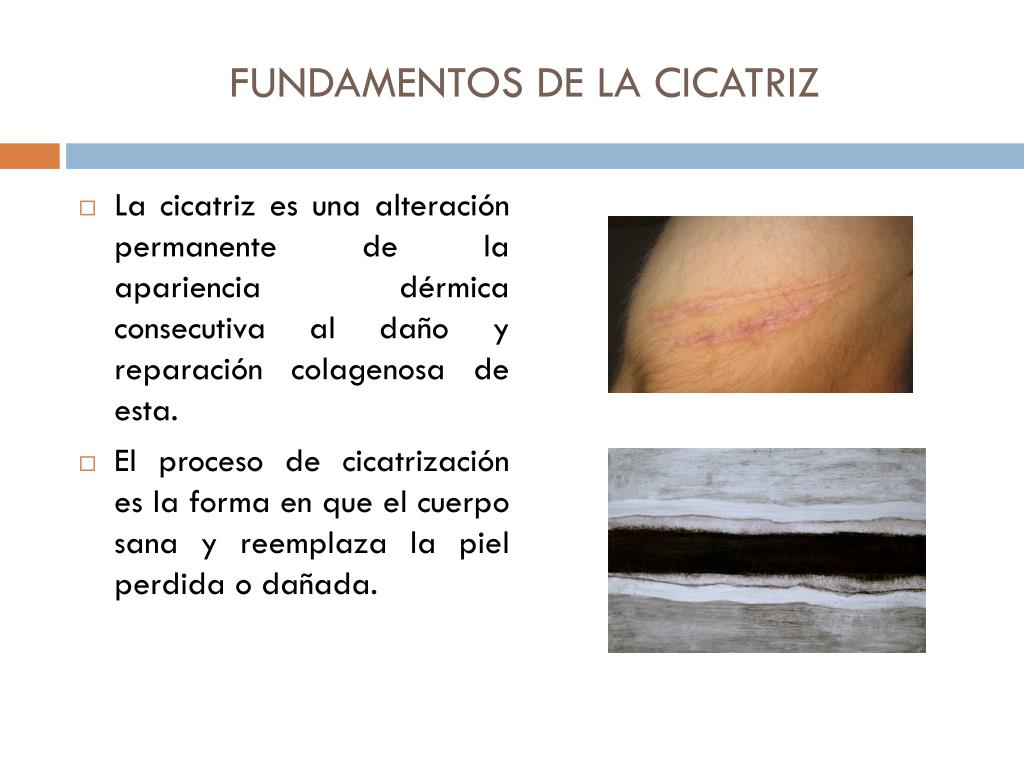 PPT - FUNDAMENTOS DE LA CICATRIZ PowerPoint Presentation, free download -  ID:5738653
