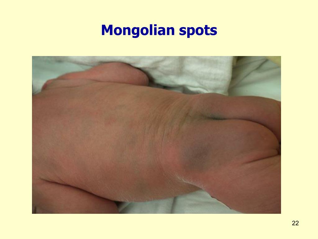 Mixed Babies Mongolian Spots At Keith Flores Blog