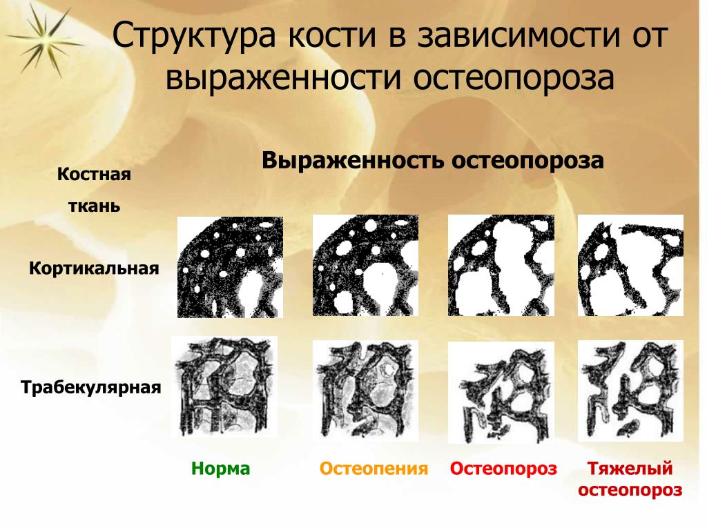 Изменение структуры кости. Патогенез сенильного остеопороза. Этиология и патогенез остеопороза. Трабекулярный остеопороз это. Остеопороз этиология.