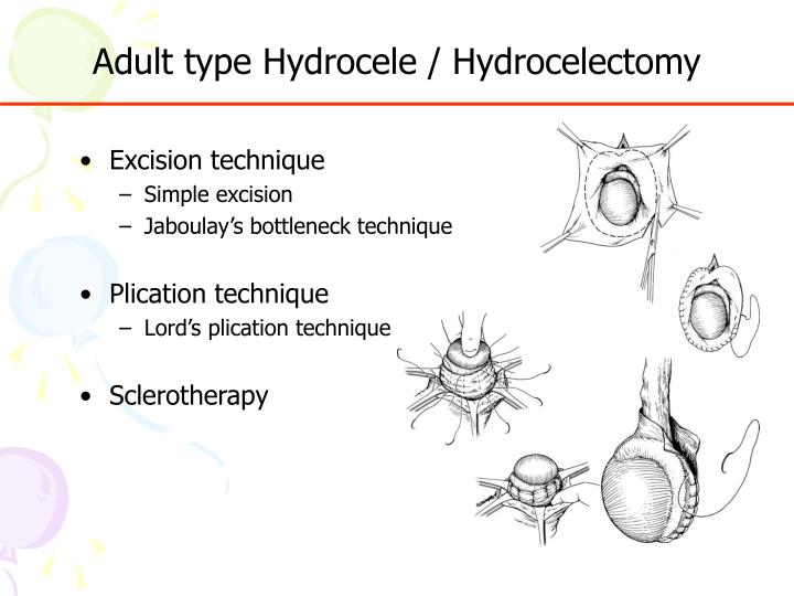 PPT Surgical Treatment of Hydrocele & Hernia PowerPoint Presentation ID5751388