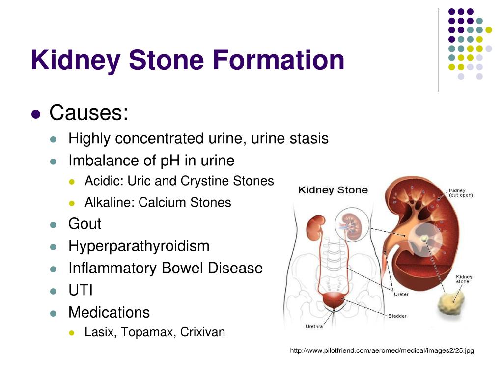 case presentation on kidney stones
