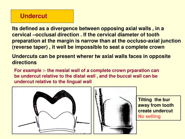 Undercut Area In Dentistry