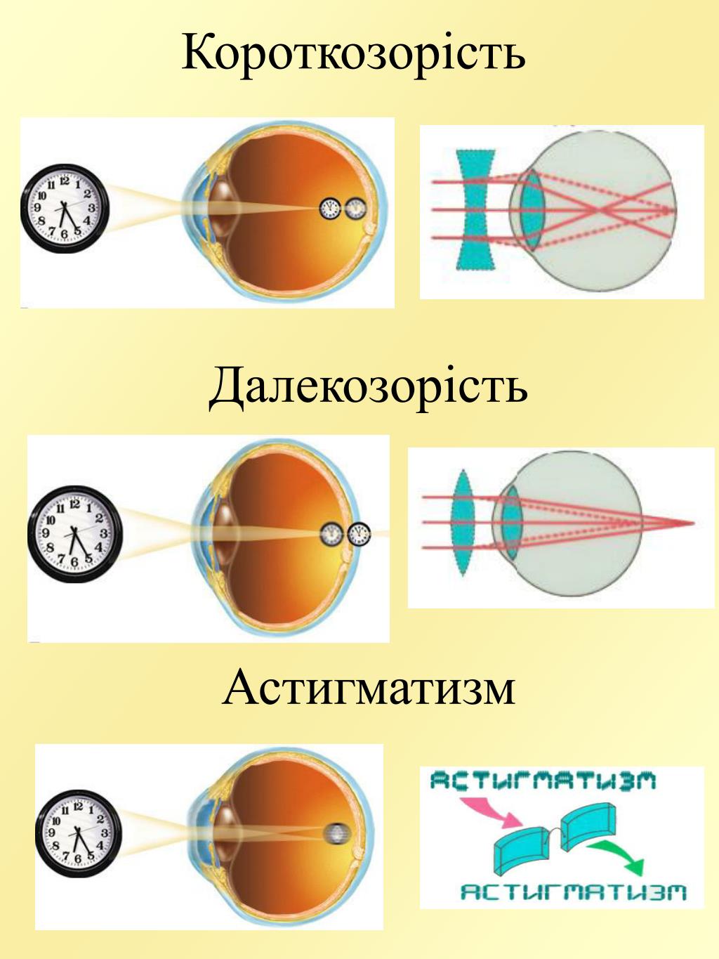 Миопия астигматизм глаз. Близорукость. Зрение близорукость. Зрение при близорукости. Близорукий астигматизм.