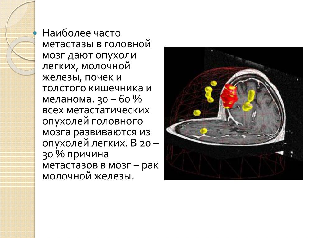 Метастазы в мозг прогноз. Опухоль головного мозга метастазы. Источники метастазов в головной мозг. Опухоль наиболее частые метастазирующая в сердце.