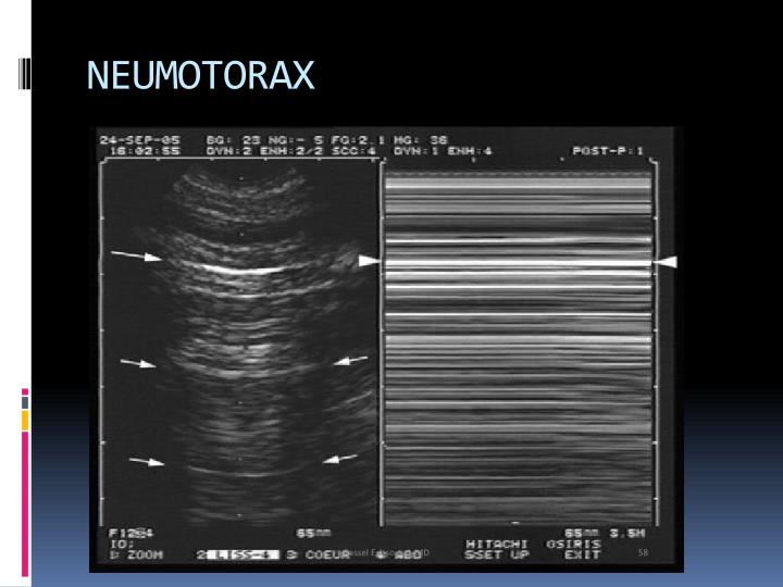 ppt-ecografia-pulmonar-powerpoint-presentation-id-5786344