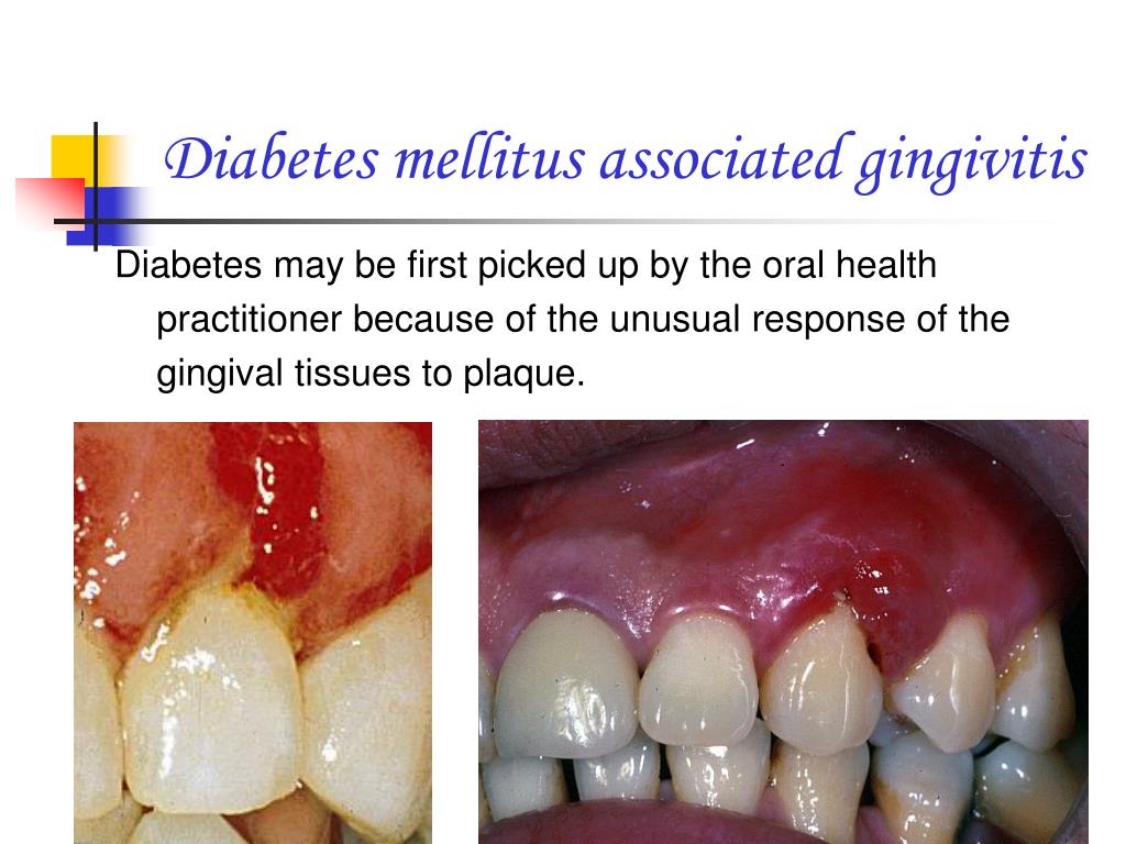 PPT Preclinical Periodontics PowerPoint Presentation, free download