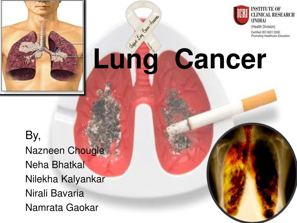 case study on lung cancer ppt