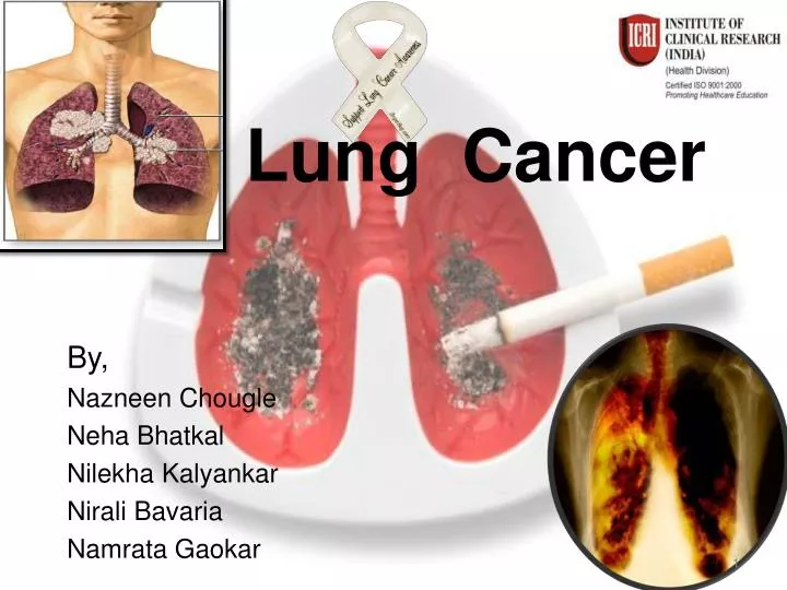 lung cancer n.