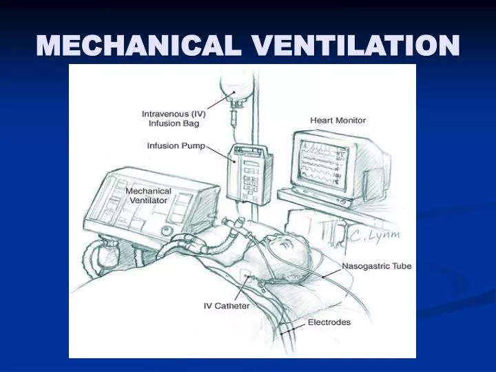 mechanical ventilation n.