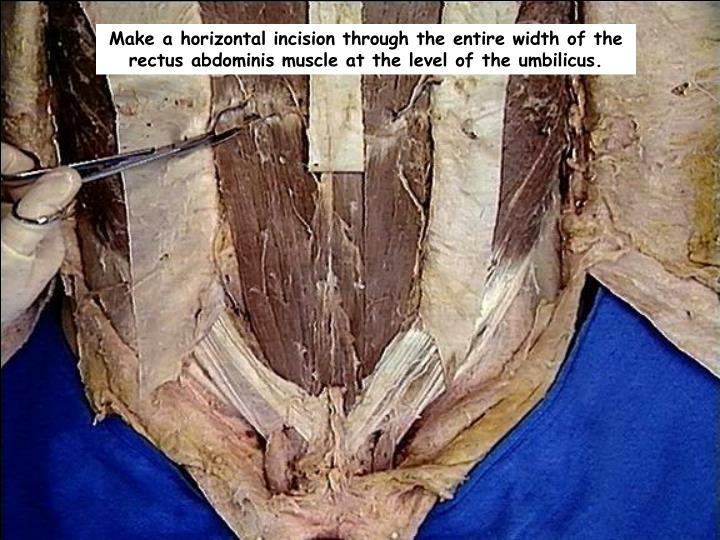 PPT - DISSECTION OF THE ANTERIOR ABDOMINAL WALL PowerPoint Presentation