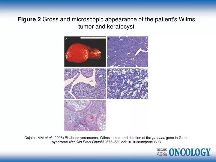 PPT - Figure 2 Gross and microscopic appearance of the patient's Wilms ...