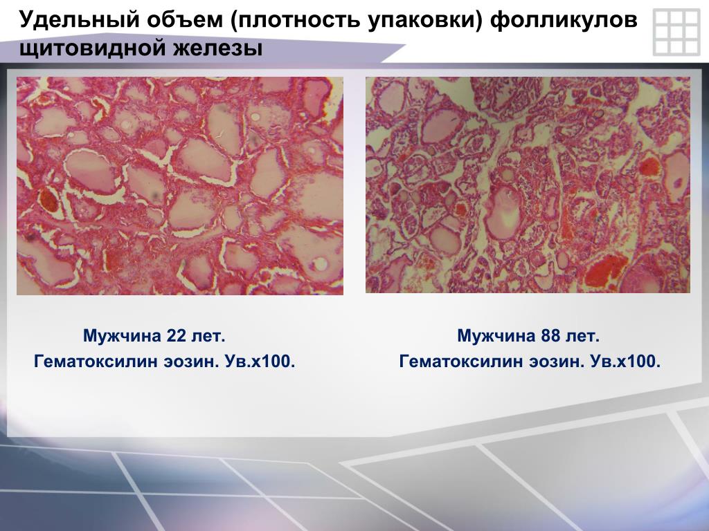 Придаточные железы мужчины. Фолликулы щитовидной железы (гематоксилин-эозин). Гематоксилин железистый и эозин отличие. Гематоксилин эозин в щитовидной железы в какой цвет что красит.
