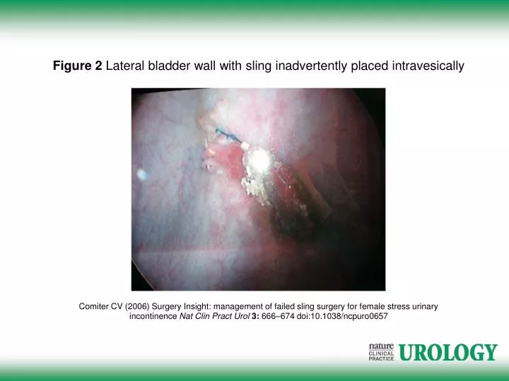 PPT Figure 2 Lateral bladder wall with sling inadvertently placed
