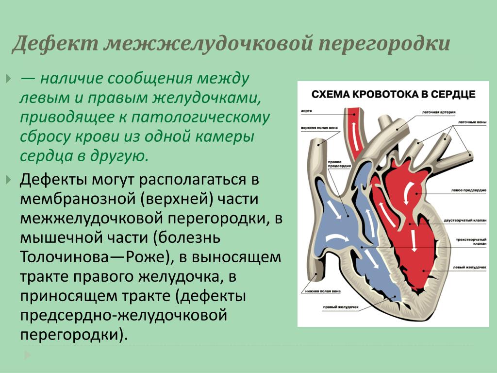 Четырехкамерное сердце наличие диафрагмы кожные покровы. Врожденный порок сердца дефект межжелудочной перегородки. Клинические симптомы дефекта межжелудочковой перегородки. Дефект предсердно-желудочковой перегородки.