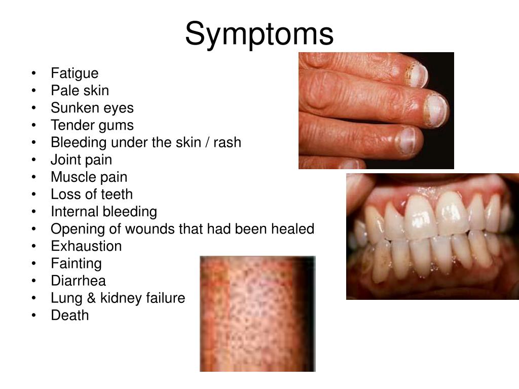PPT What Is Scurvy PowerPoint Presentation Free Download ID 5843828