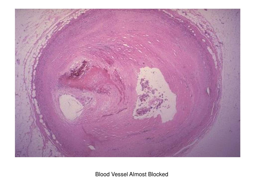 Тромб микропрепарат. Красный тромб микропрепарат. Организованный тромб в артерии микропрепарат. Тромб артерии микропрепарат. Белый тромб в артерии микропрепарат.