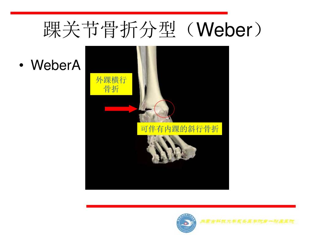 Ppt 踝关节损伤danis Weber 分型及其机制powerpoint Presentation Id