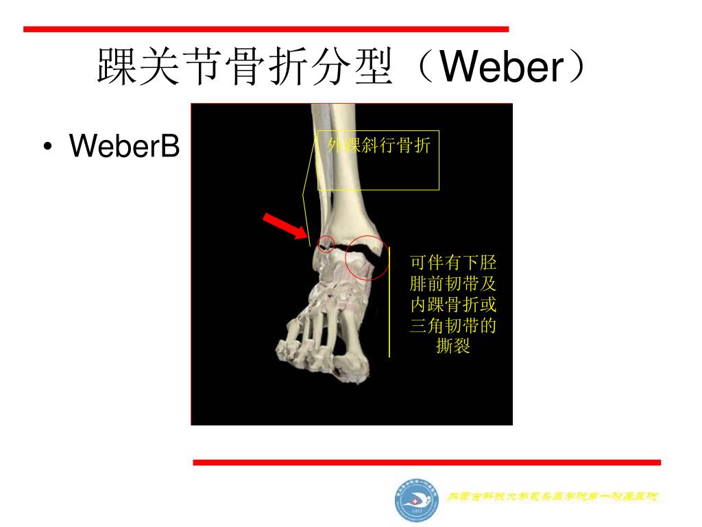 Ppt 踝关节损伤danis Weber 分型及其机制powerpoint Presentation Id