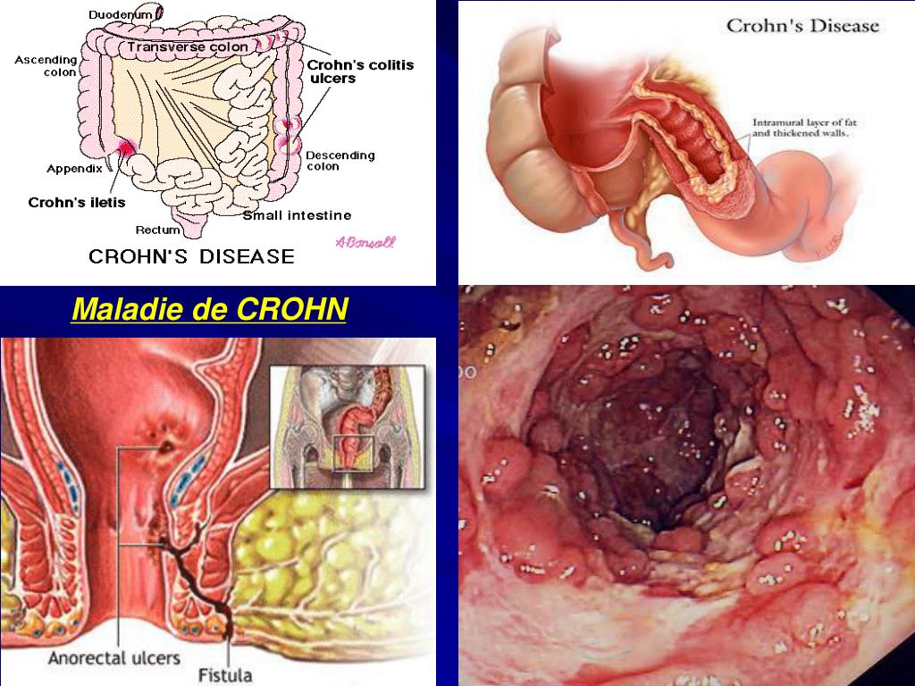 Colitis sintomas en mujeres