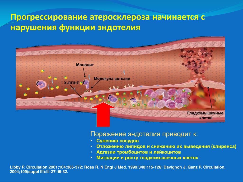 Презентация по теме атеросклероз