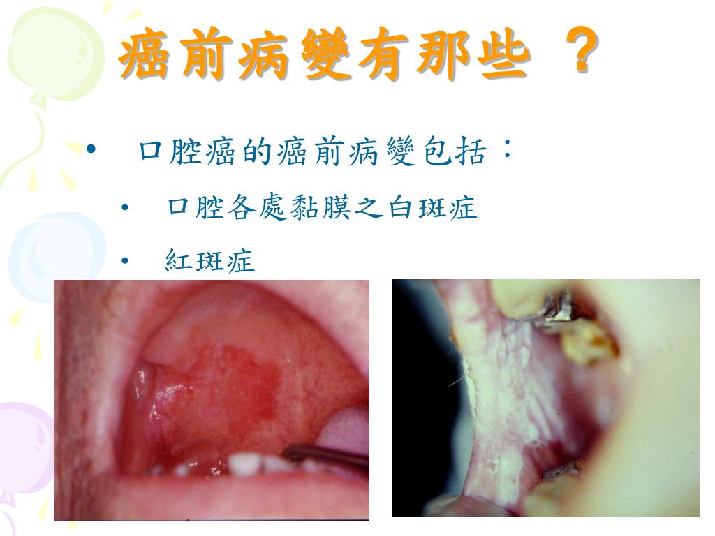 舌がん・口腔がんとは？ | 舌がん・口腔がん 何科を受診すればいいの？ | 日本耳鼻咽喉科学会