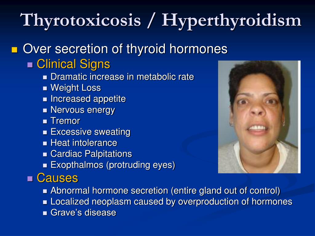 hyperthyroidism sweating