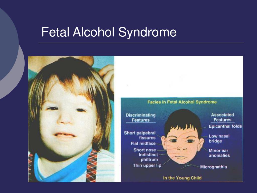 Признаки фетального алкогольного. Фетальный алкогольный синдром Эвелинушка. Фитально алкогольный синдром. Фетальный алкогольный синдром у детей. Алкогольный синдром у детей.