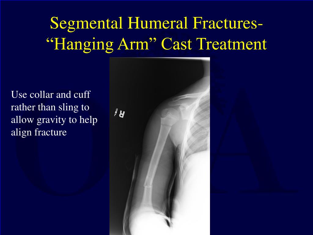 PPT - Fractures and Dislocations about the Shoulder in the Pediatric  Patient PowerPoint Presentation - ID:5943420