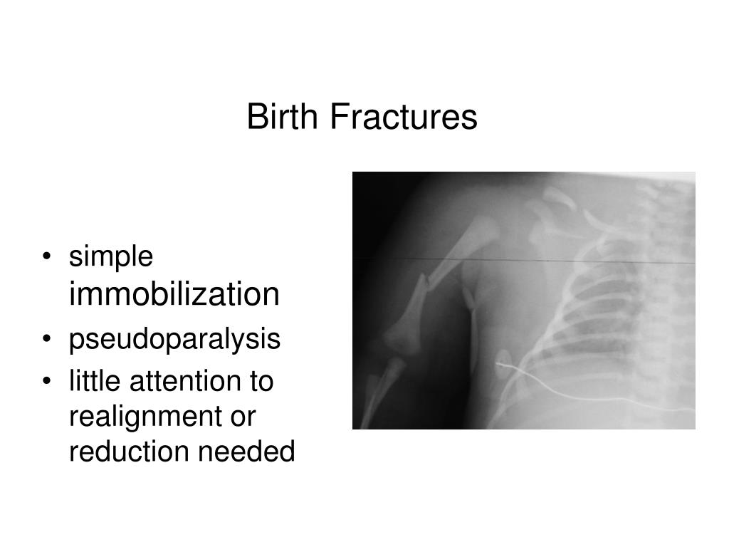 PPT - Proximal Humeral Fracture in Children PowerPoint ...
