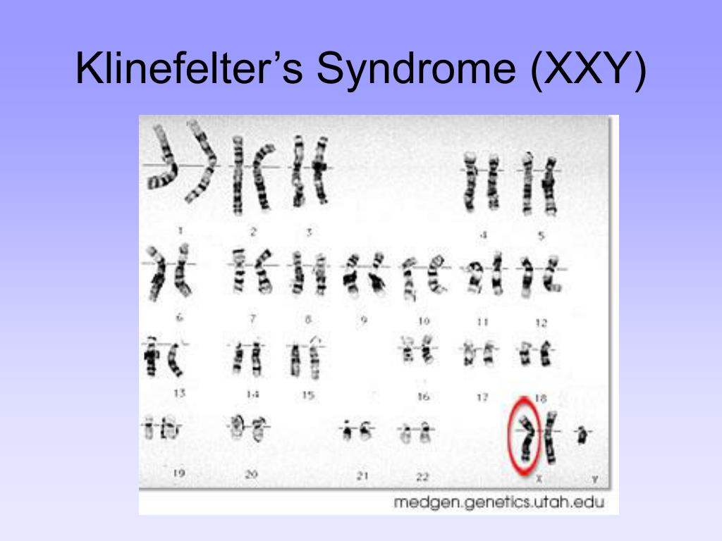 Xxy хромосома. Синдром Клайнфельтера кариограмма. Синдром Клайнфельтера хромосомы. Синдром Клайнфельтера гетероплоидия. Кариотип Клайнфельтера.