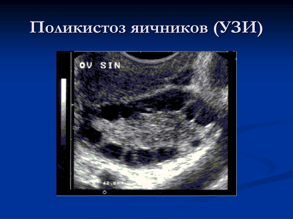 При поликистозе можно забеременеть. УЗИ признаки поликистоза яичников. Синдром поликистоза яичников на УЗИ. Снимок УЗИ поликистоз яичников.