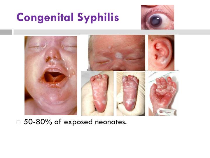 Hasil gambar untuk bayi dengan sifilis
